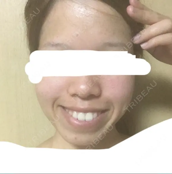 糸リフト / バッカルファット除去 / ボトックス（エラ・小顔） 湘南美容クリニック 静岡院 DAY 22 メイン用