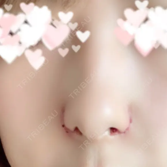 小鼻縮小（切開） 品川美容外科 仙台院 AFTER メイン用