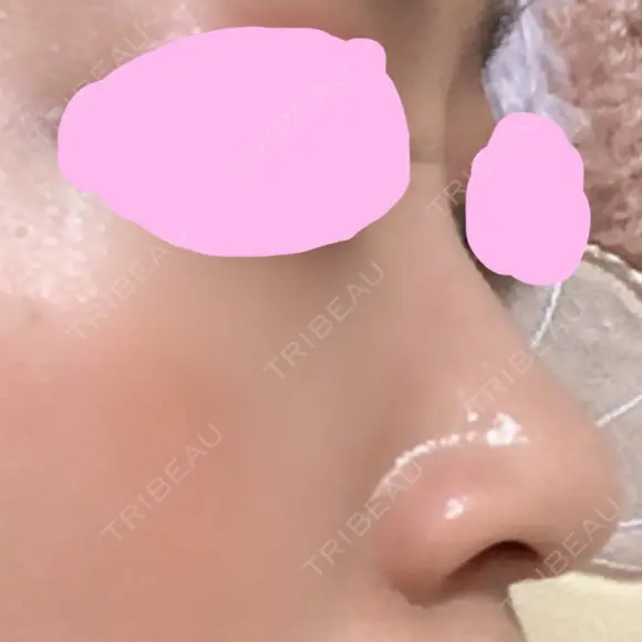 ヒアルロン酸注入（鼻） 神田美容外科形成外科医院 DAY 2 メイン用