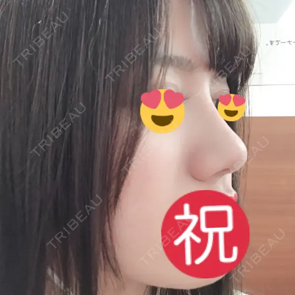 隆鼻術 / 小鼻縮小（切開） / 鼻修正 ルラ美容クリニック 高田馬場院 AFTER メイン用