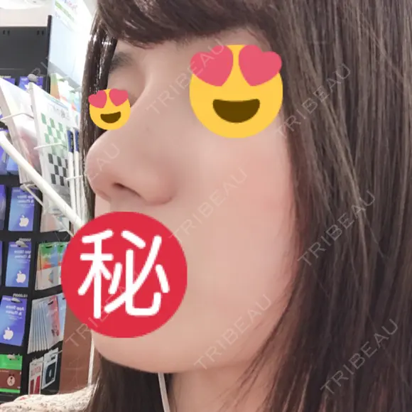 隆鼻術 / 小鼻縮小（切開） / 鼻修正 ルラ美容クリニック 高田馬場院 DAY 37 メイン用