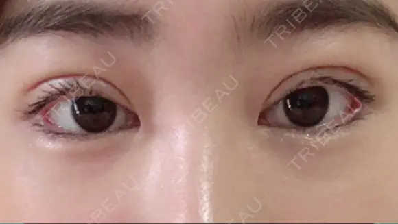 二重埋没 / 眼瞼下垂（切開） / 目尻切開 / 蒙古ひだ形成 / タレ目形成・グラマラスライン（切開） POP美容整形クリニック DAY 28 メイン用