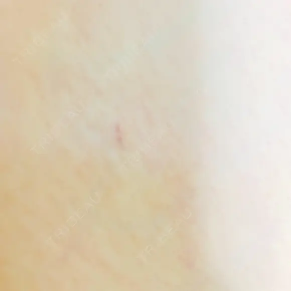 クマ治療 / 額を丸く / 脂肪吸引（脚） / レディエッセ注入（鼻） THE CLINIC（ザ・クリニック） 東京院 DAY 33 メイン用