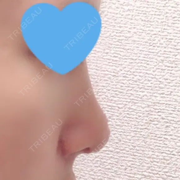 隆鼻術 / 鼻尖形成（切開） / 鼻中隔延長（切開） / 小鼻縮小（切開） / 骨切幅寄せ / ワシ鼻修正・ハンプ切除 / 鼻尖縮小 FROM B整形外科 (旧バウム整形外科) DAY 62 メイン用