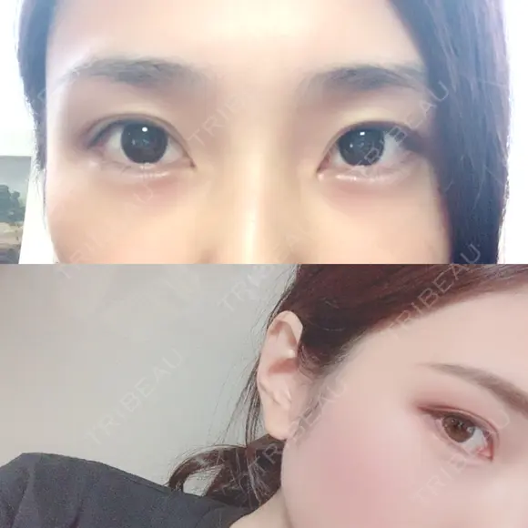ヒアルロン酸注入（涙袋） フィラークリニック 恵比寿院 AFTER メイン用