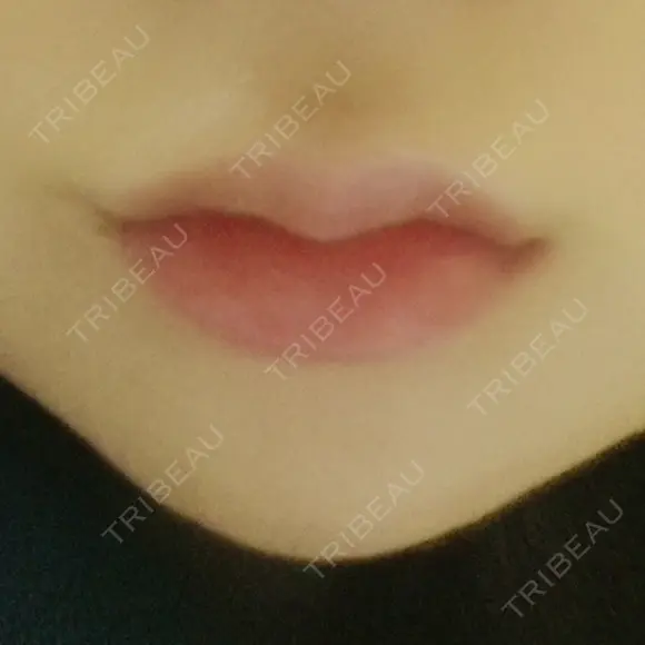 ボトックス（エラ・小顔） / 脂肪溶解注射（顔） / ヒアルロン酸注入（唇） / ボトックス（口角） the way（ザウェイ）整形外科 DAY 1 メイン用