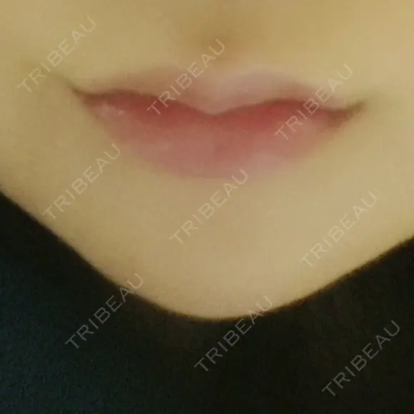 ボトックス（エラ・小顔） / 脂肪溶解注射（顔） / ヒアルロン酸注入（唇） / ボトックス（口角） the way（ザウェイ）整形外科 DAY 1 メイン用