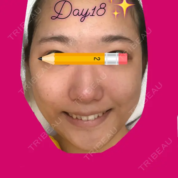 目頭切開 / バッカルファット除去 / 脂肪吸引（顔） / 目尻切開 / タレ目形成・グラマラスライン（切開） / その他（目元） RG整形外科（旧リオン整形外科） DAY 18 メイン用