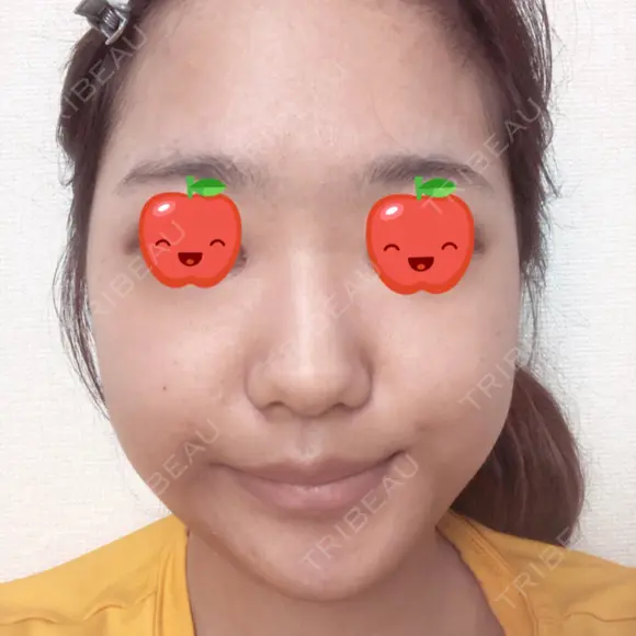 目頭切開 / バッカルファット除去 / 脂肪吸引（顔） / 目尻切開 / タレ目形成・グラマラスライン（切開） / その他（目元） RG整形外科（旧リオン整形外科） DAY 20 メイン用