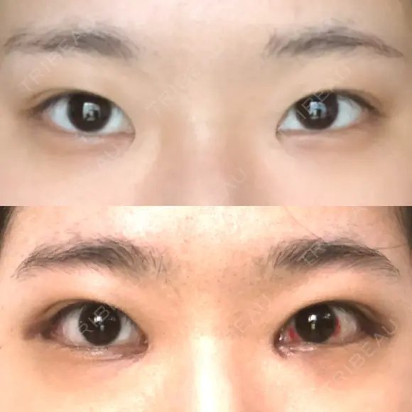 目頭切開 / バッカルファット除去 / 脂肪吸引（顔） / 目尻切開 / タレ目形成・グラマラスライン（切開） / その他（目元） RG整形外科（旧リオン整形外科） DAY 20 メイン用