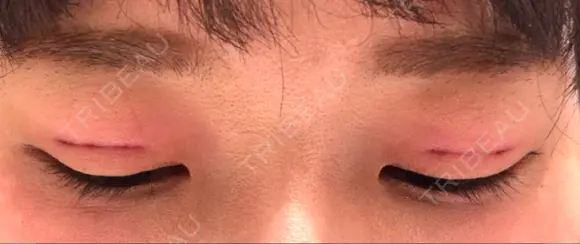 二重埋没 品川美容外科 仙台院 DAY 0 メイン用