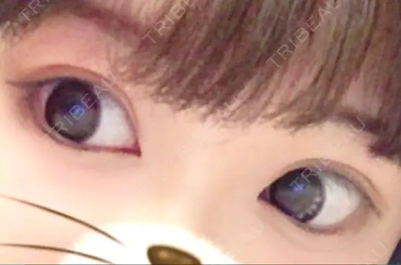 二重埋没 品川美容外科 仙台院 DAY 10 メイン用