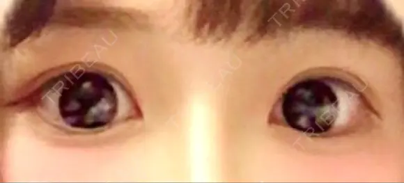 二重埋没 品川美容外科 仙台院 DAY 30 メイン用