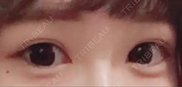 二重埋没 品川美容外科 仙台院 DAY 90 メイン用