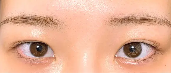 二重埋没 品川美容外科 仙台院 DAY 790 メイン用