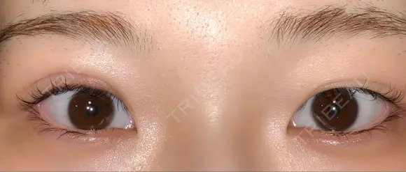 二重埋没 品川美容外科 仙台院 DAY 790 メイン用