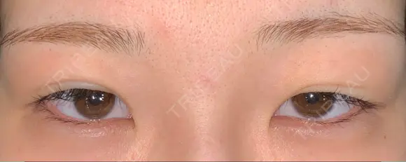 二重埋没 品川美容外科 仙台院 AFTER メイン用