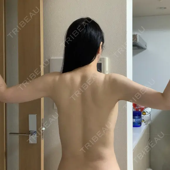 その他（ボディ） / 脂肪溶解注射（二の腕） / ハイフ（顔） クリム整形外科 DAY 45 メイン用