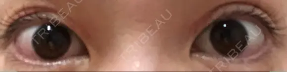 二重切開 / 上まぶたたるみ取り / 目元修正 神野美容形成外科クリニック DAY 20 メイン用