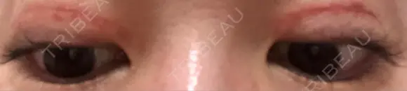 二重切開 / 上まぶたたるみ取り / 目元修正 神野美容形成外科クリニック DAY 20 メイン用