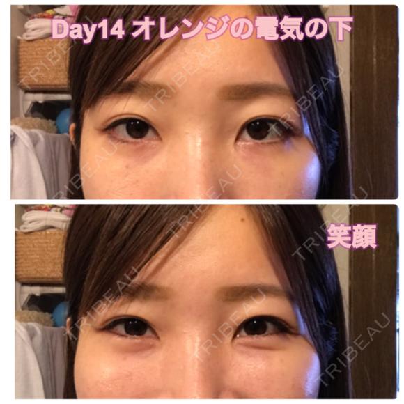 クマ治療 / 下まぶたたるみ取り / 下まぶたの脂肪取り セオリークリニック DAY 14 メイン用