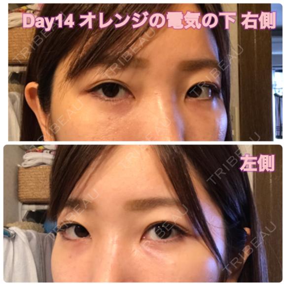 クマ治療 / 下まぶたたるみ取り / 下まぶたの脂肪取り セオリークリニック DAY 14 メイン用