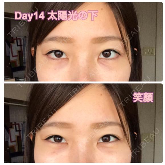 クマ治療 / 下まぶたたるみ取り / 下まぶたの脂肪取り セオリークリニック DAY 14 メイン用