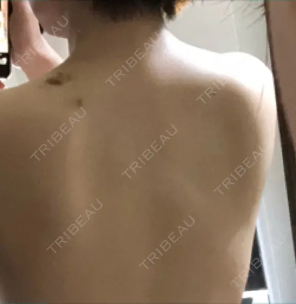 ボトックス（あご） / ボトックス（エラ・小顔） / その他 洗足整形・形成外科 DAY 3 メイン用