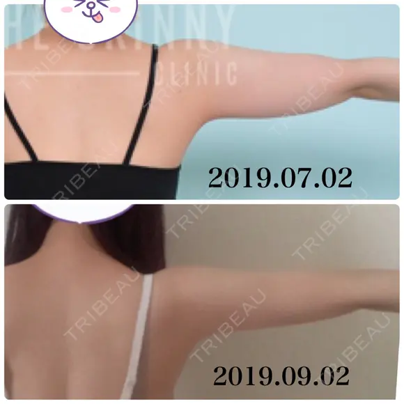 脂肪溶解注射（二の腕） / ボトックス（肩） / その他（ボディ） THE SKINNY CLINIC（ザ・スキニークリニック） AFTER メイン用