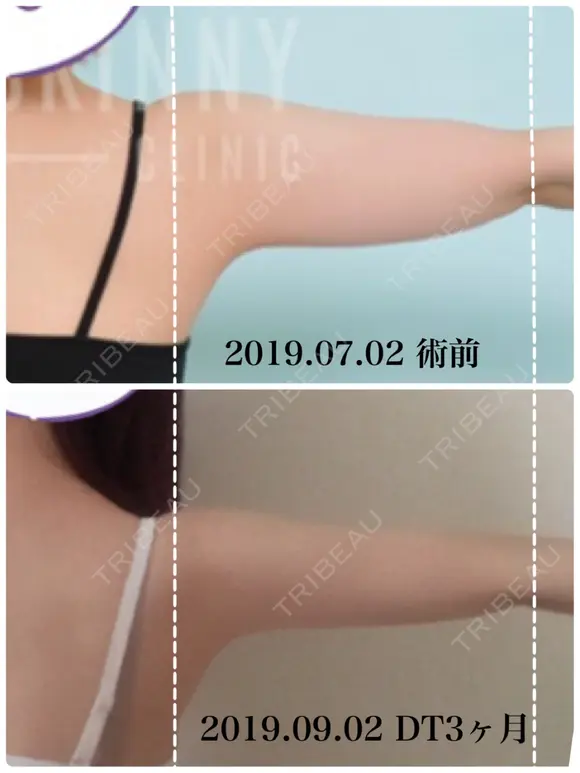 脂肪溶解注射（二の腕） / ボトックス（肩） / その他（ボディ） THE SKINNY CLINIC（ザ・スキニークリニック） DAY 62 メイン用