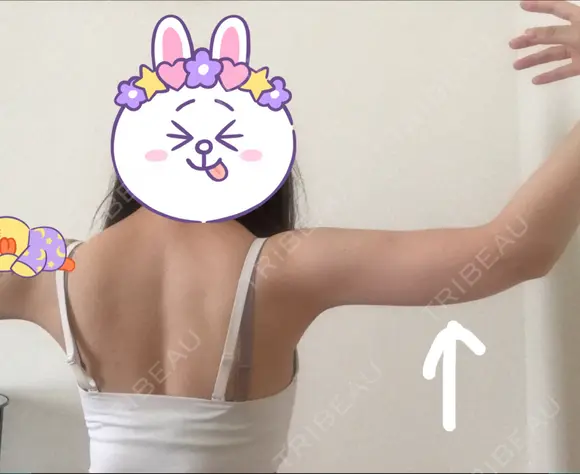 脂肪溶解注射（二の腕） / ボトックス（肩） / その他（ボディ） THE SKINNY CLINIC（ザ・スキニークリニック） DAY 62 メイン用