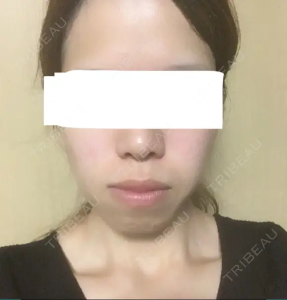 糸リフト / バッカルファット除去 / ボトックス（エラ・小顔） 湘南美容クリニック 静岡院 DAY 33 メイン用