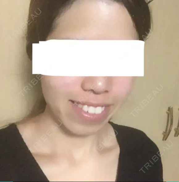 糸リフト / バッカルファット除去 / ボトックス（エラ・小顔） 湘南美容クリニック 静岡院 DAY 33 メイン用
