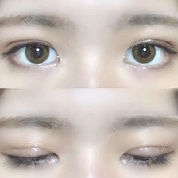 二重埋没 / 眼瞼下垂（切開） アリナガ美容外科 DAY 27 メイン用