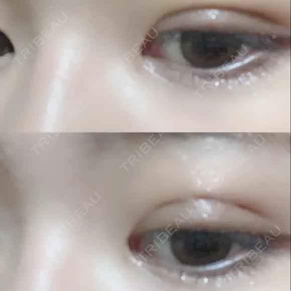 二重埋没 / 眼瞼下垂（切開） アリナガ美容外科 DAY 27 メイン用