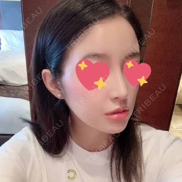 鼻尖形成（切開） / 鼻中隔延長（切開） / 脂肪注入（額） / 脂肪注入（輪郭） ビーザニュー美容整形外科（旧コノピ美容整形外科） AFTER メイン用