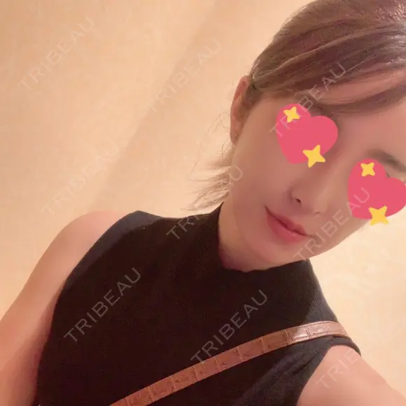 鼻尖形成（切開） / 鼻中隔延長（切開） / 脂肪注入（額） / 脂肪注入（輪郭） ビーザニュー美容整形外科（旧コノピ美容整形外科） DAY 155 メイン用