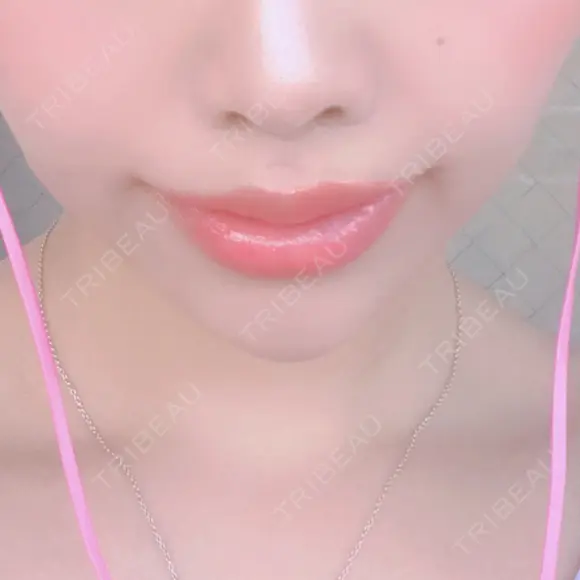 人中短縮 / 口角挙上 清潭女神美容外科 AFTER メイン用