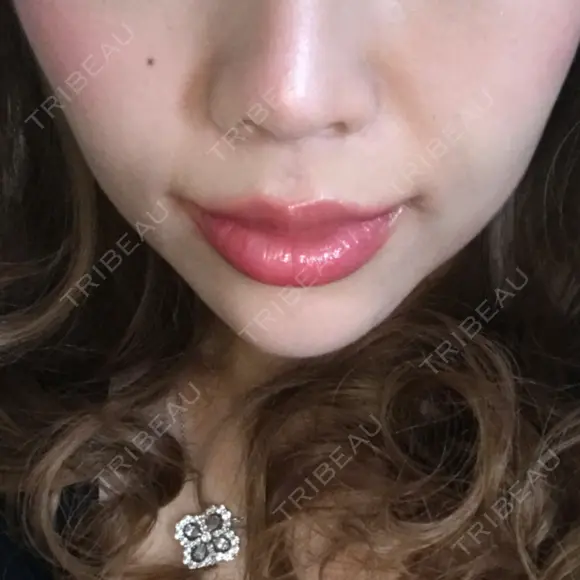 人中短縮 / 口角挙上 清潭女神美容外科 DAY 60 メイン用