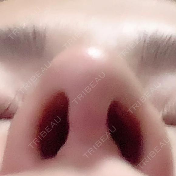 隆鼻術 / 鼻尖形成（切開） / 鼻中隔延長（切開） / 軟骨移植 / プロテーゼ除去 / 鼻修正 湘南美容クリニック 新宿本院 DAY 183 メイン用