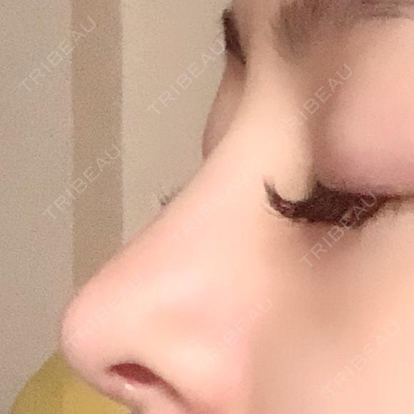 隆鼻術 / 鼻尖形成（切開） / 鼻中隔延長（切開） / 軟骨移植 / プロテーゼ除去 / 鼻修正 湘南美容クリニック 新宿本院 DAY 183 メイン用