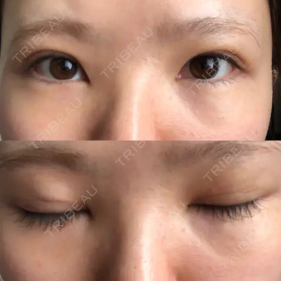 二重埋没 / 下まぶたの脂肪取り / ボトックス（エラ・小顔） 表参道スキンクリニック 表参道院 DAY 5 メイン用