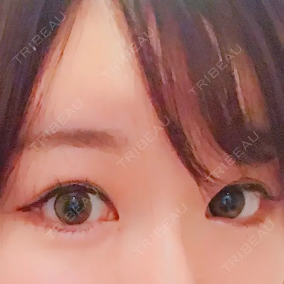 目尻切開 / タレ目形成・グラマラスライン（切開） シエルクリニック AFTER メイン用