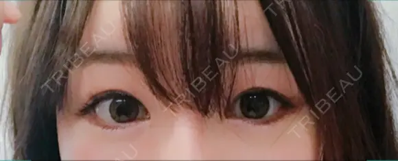 目尻切開 / タレ目形成・グラマラスライン（切開） シエルクリニック DAY 50 メイン用