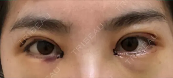 二重切開 / 目頭切開 / 眼瞼下垂（切開） / 目尻切開 ジュエリー美容外科 DAY 4 メイン用