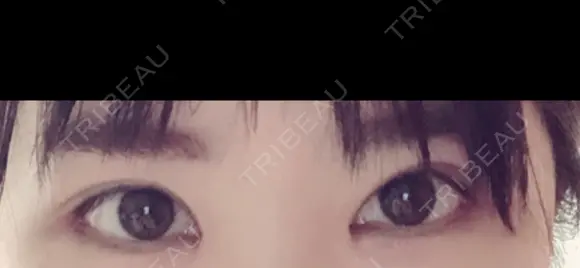 二重切開 / 目頭切開 / 眼瞼下垂（切開） / 目尻切開 ジュエリー美容外科 DAY 19 メイン用