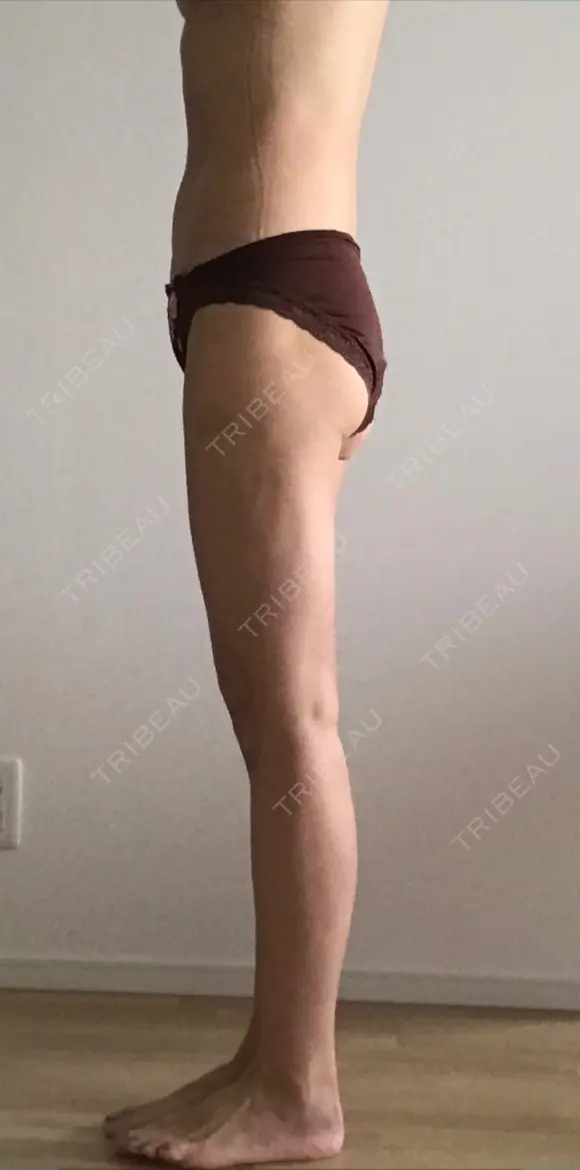 脂肪吸引（脚） / 脂肪吸引（お腹） / 脂肪吸引（お尻） ラインカルチャークリニック DAY 84 メイン用