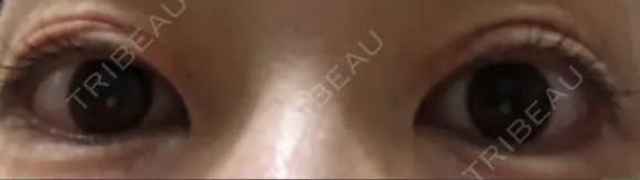 二重切開 / 上まぶたたるみ取り / 目元修正 神野美容形成外科クリニック DAY 28 メイン用