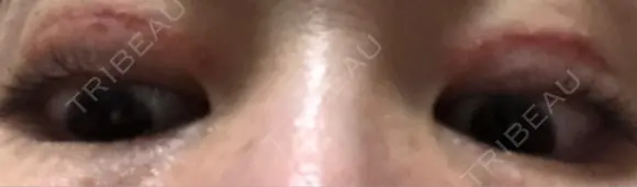 二重切開 / 上まぶたたるみ取り / 目元修正 神野美容形成外科クリニック DAY 28 メイン用