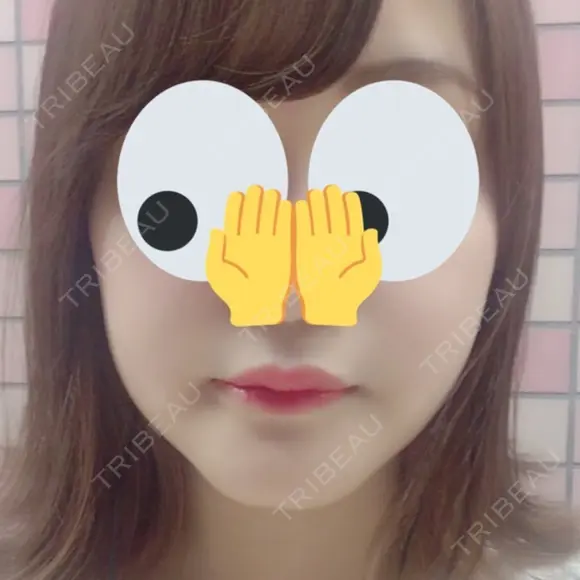 骨切り（あご） / その他（輪郭） マックスファクス銀座クリニック AFTER メイン用